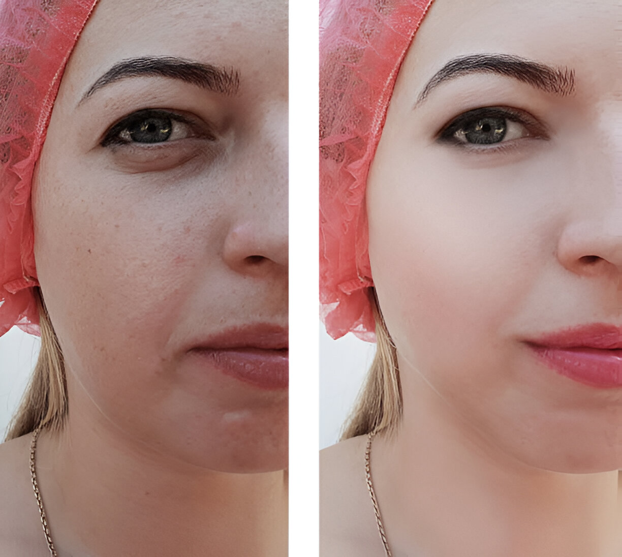 Before and after chemical peels comparison image from the practice's existing gallery