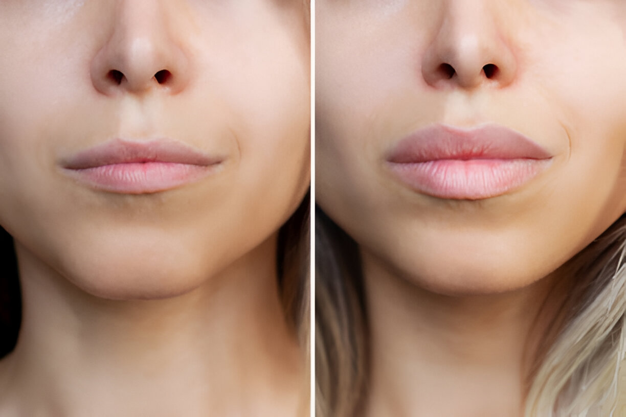 Before and after lip enhancement comparison image from the practice's existing gallery